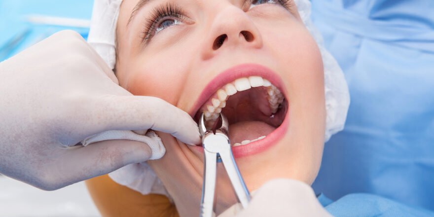 Tooth Extractions