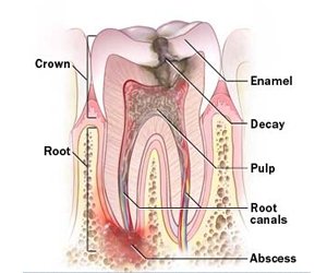 Root Canal