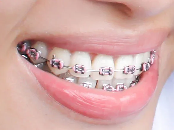 Braces