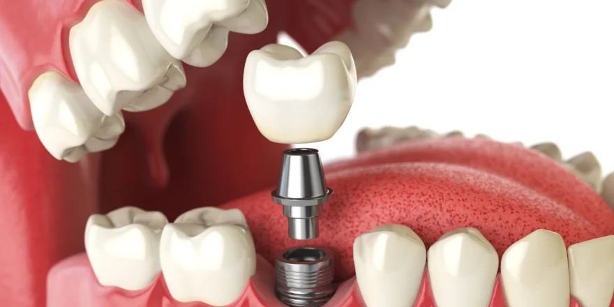 Dental-Implants3