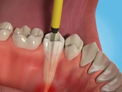 root-canal-treatment-service-500x500