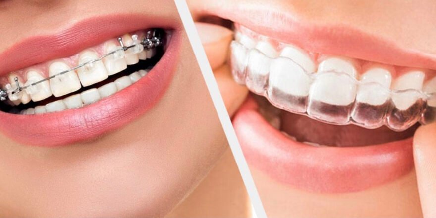 tauntonorthodontics-why-orthodontic-treatment-is-important-1