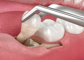 Wisdom Tooth Removal in Mysore